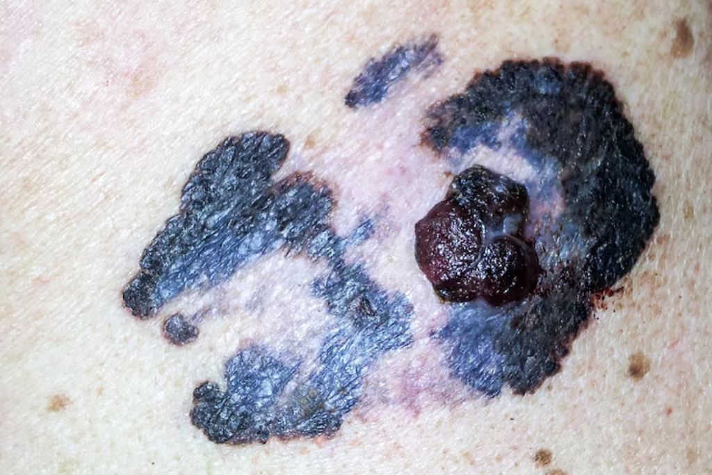 A close-up image of an irregularly shaped, darkly pigmented skin lesion with a raised center, consistent with advanced melanoma. The surrounding skin shows discoloration and asymmetry, highlighting the seriousness of sun-related health conditions.